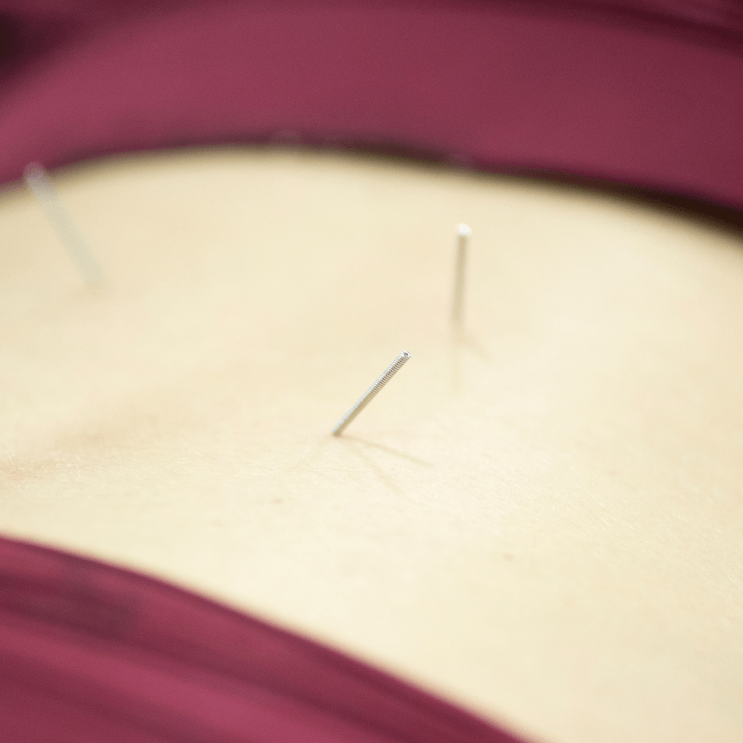Dry Needling Columbus, OH