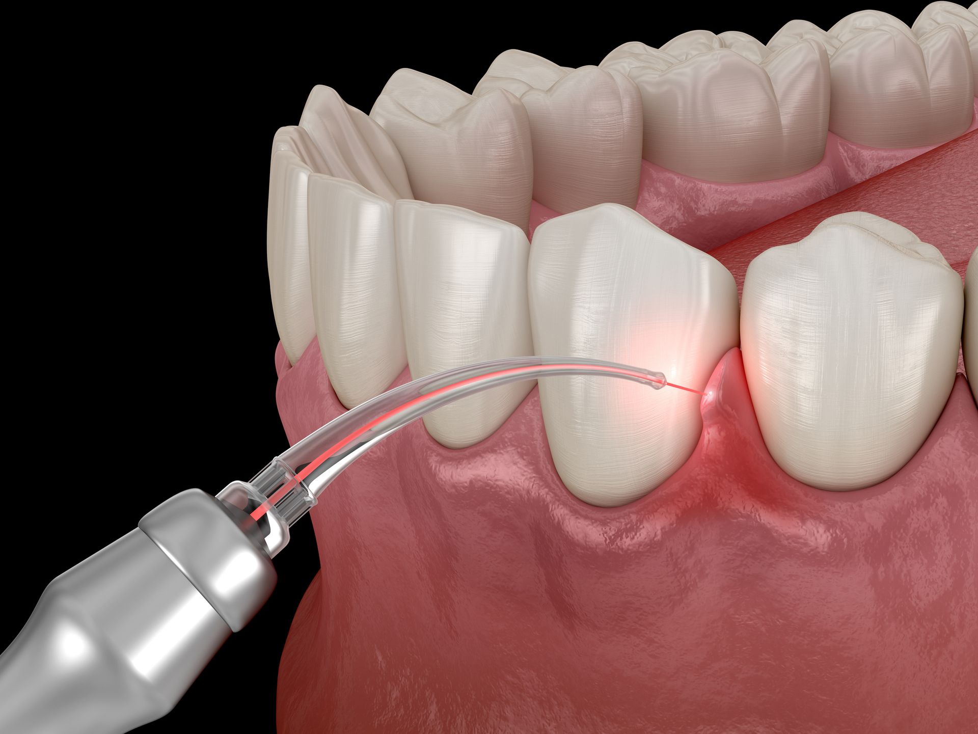 Laser dental procedure on a tooth, with red light and silver tool near gum and teeth on a black background.