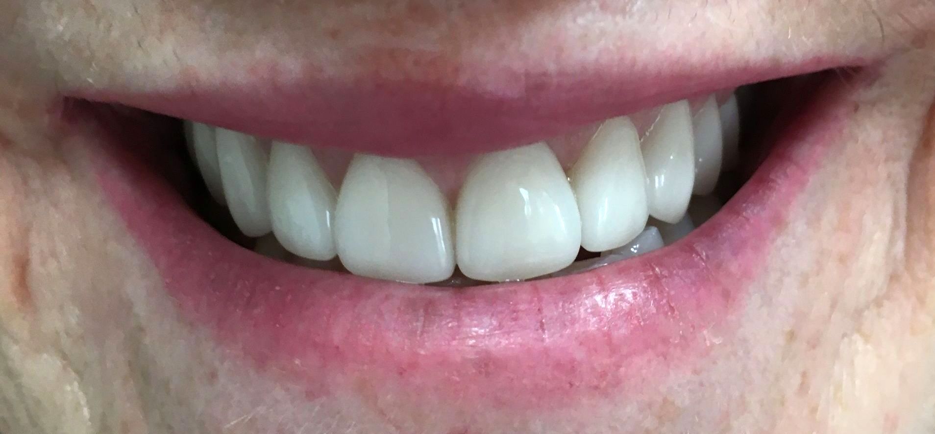 After Dental Crown Procedure — Melbourne, Vic — Ladakis Dental