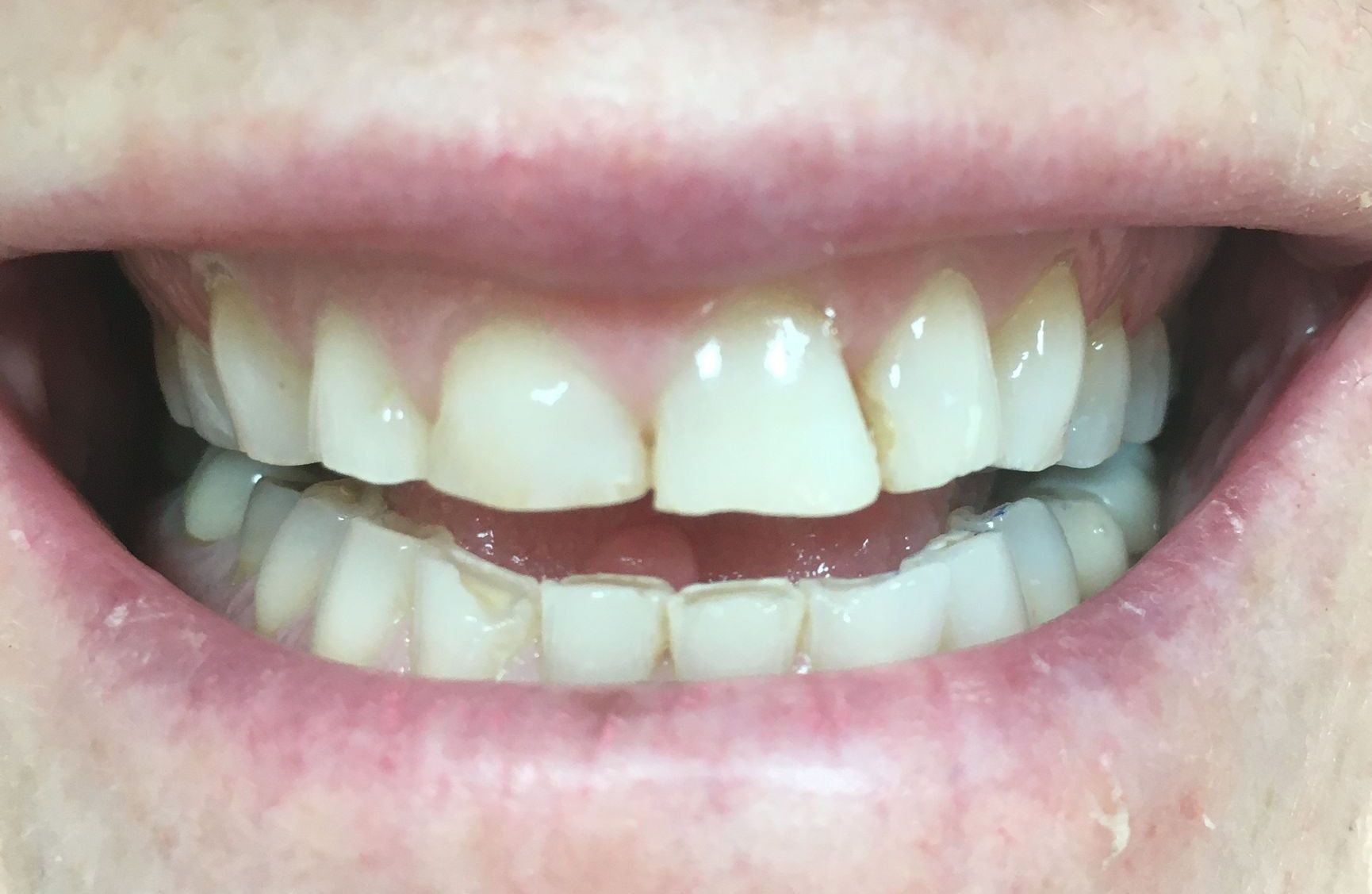 Before Dental Crown Procedure — Melbourne, Vic — Ladakis Dental