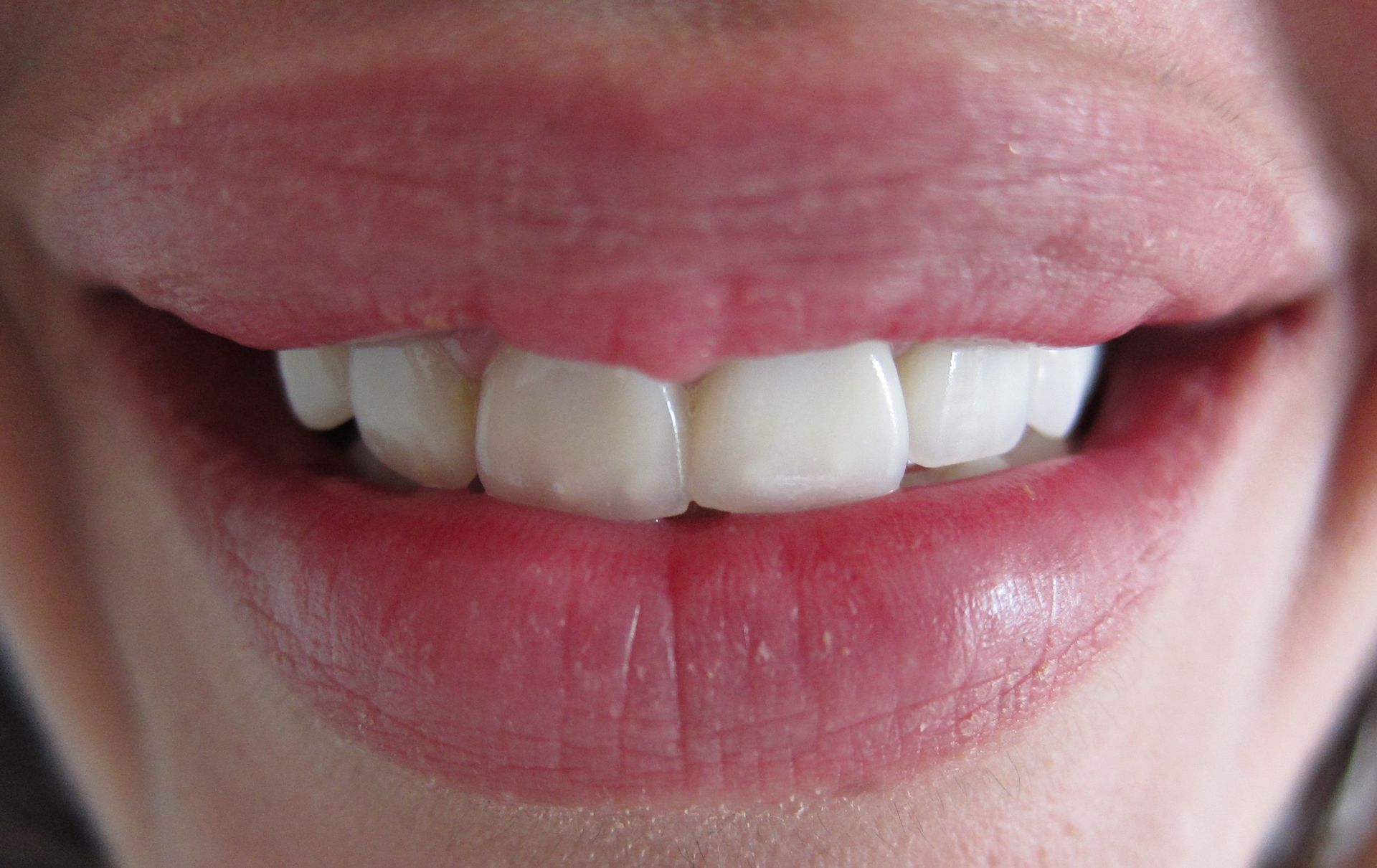 Before Teeth Whitening — Melbourne, Vic — Ladakis Dental