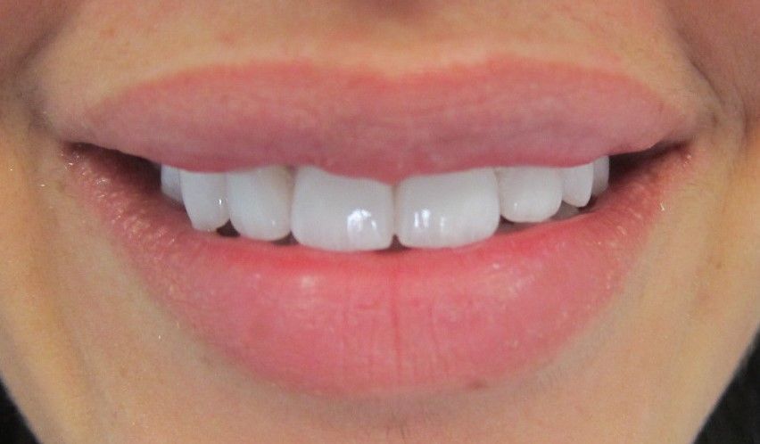 A Woman is Giving a Thumbs Up — Melbourne, VIC — Ladakis Dental