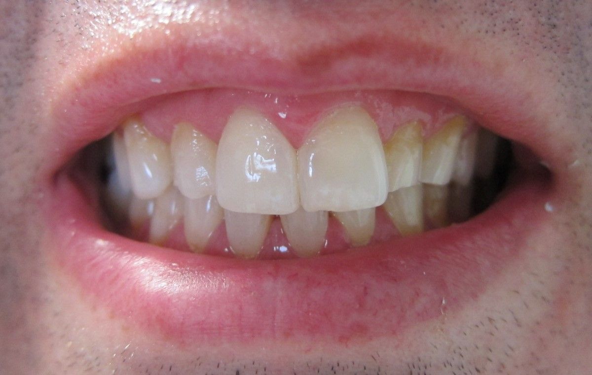 Before Man's Teeth Whitening — Melbourne, Vic — Ladakis Dental