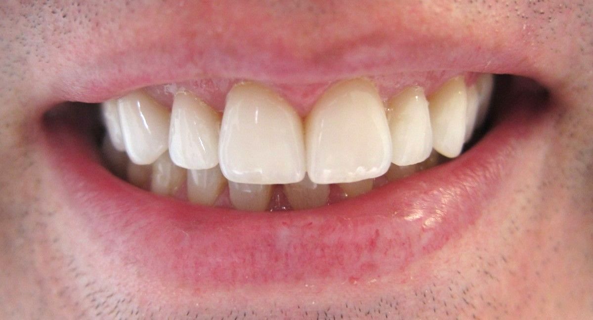 After Man's Teeth Whitening — Melbourne, Vic — Ladakis Dental