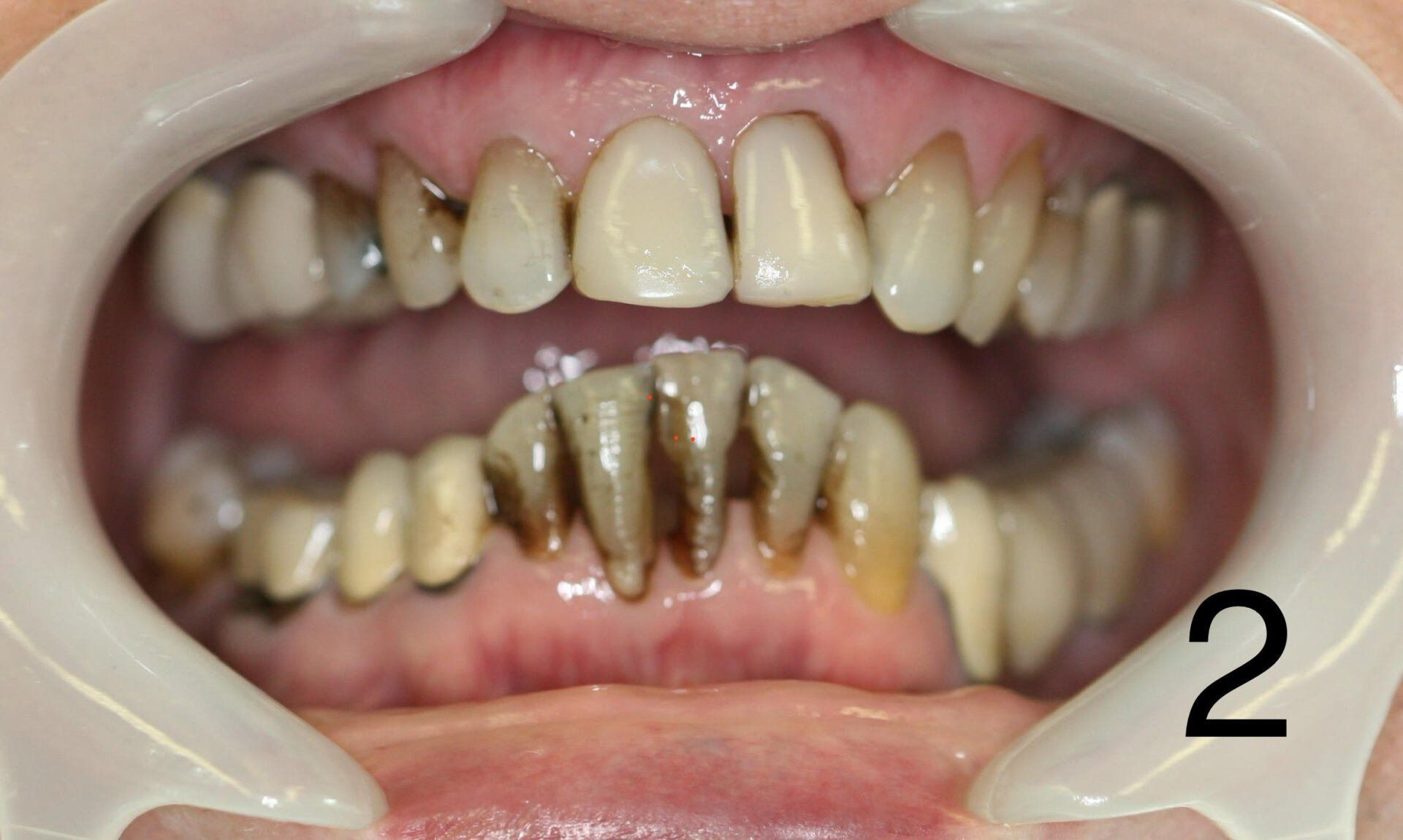 restorative before