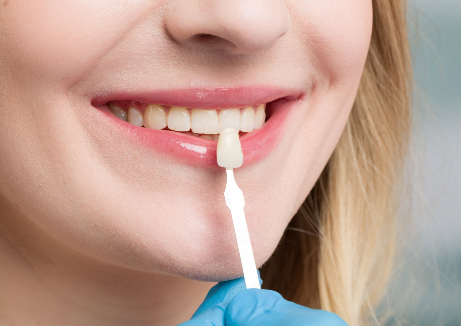 dentist color matches veneers to patient's teeth