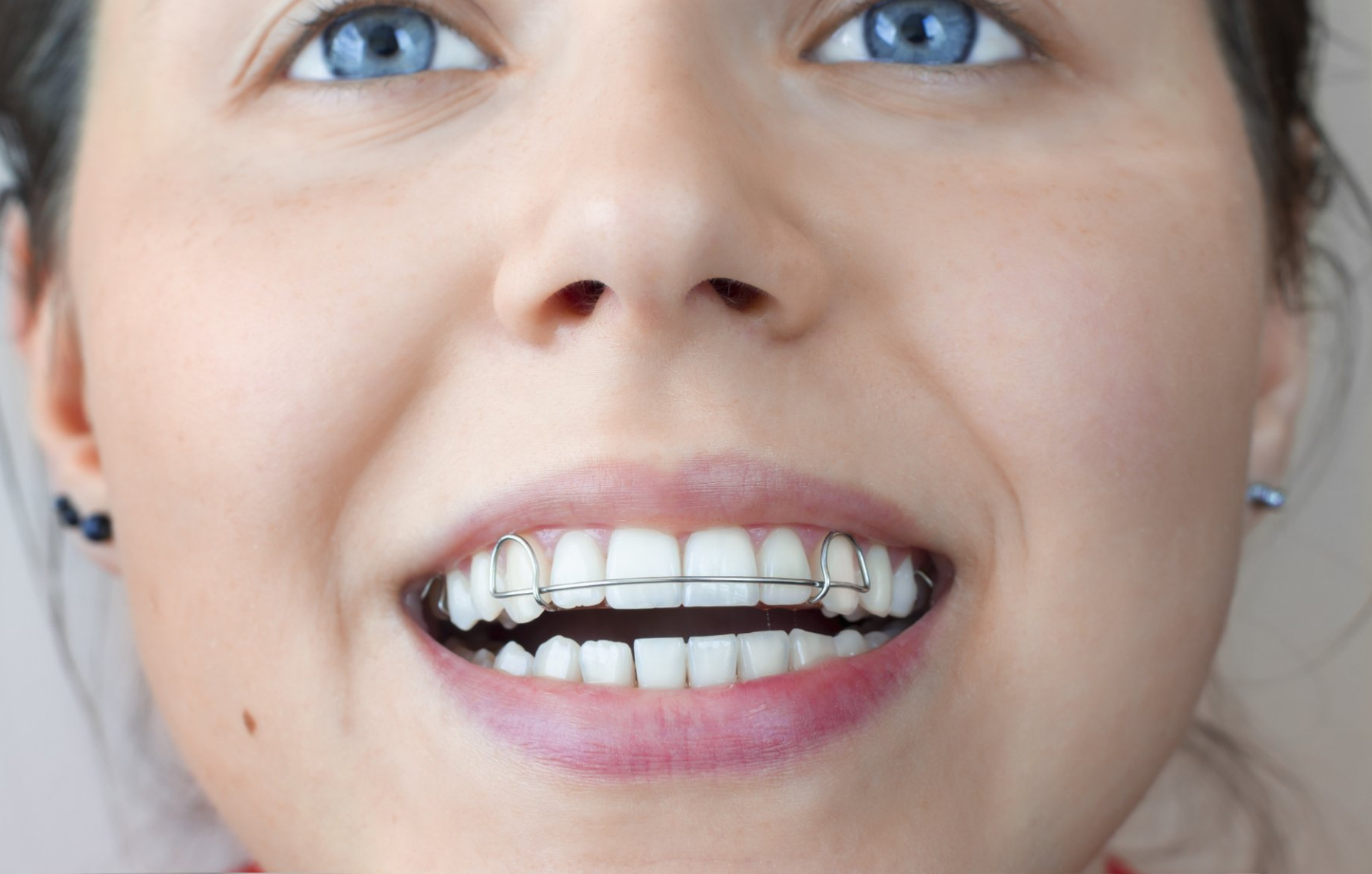 young woman wearing retainer to straighten top teeth