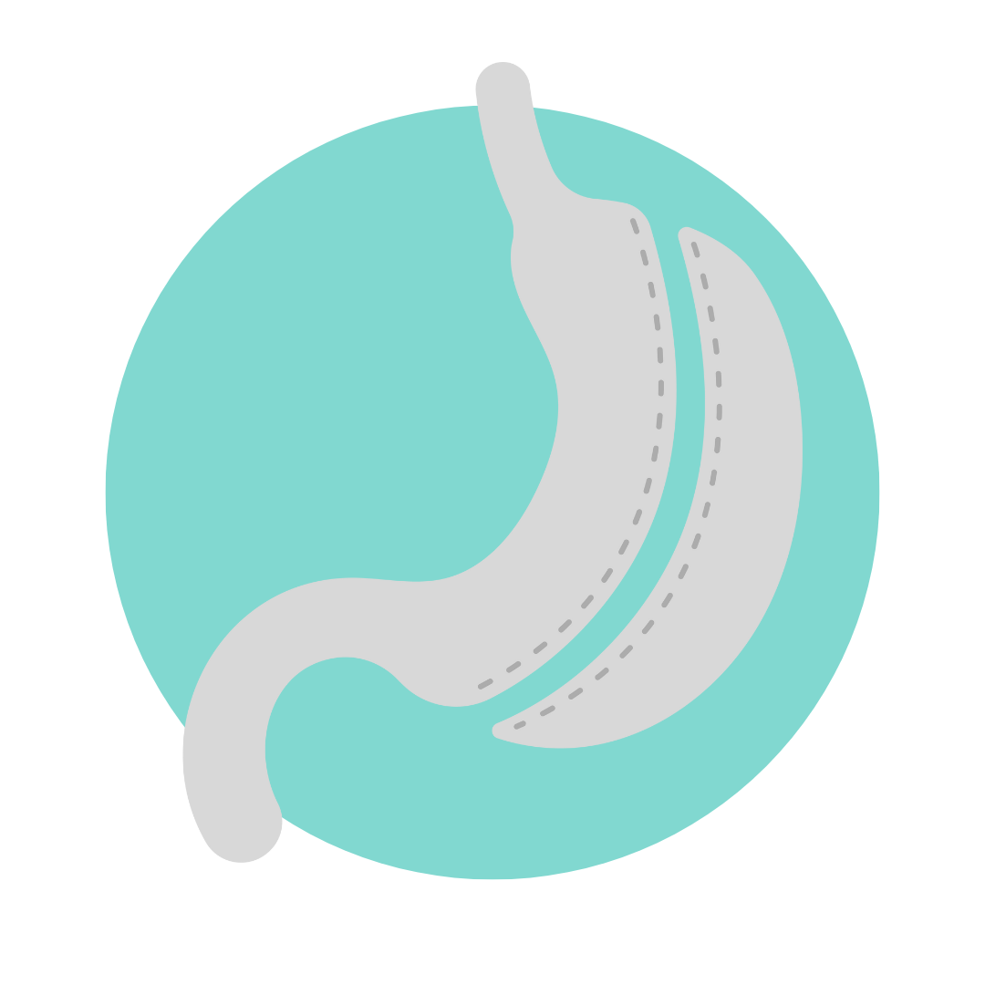 Gastric Sleeve