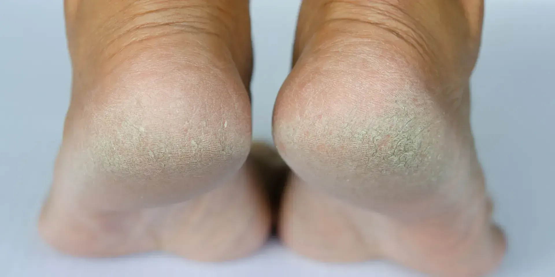 Two human heels showing dry, cracked, and calloused skin against a plain light background.