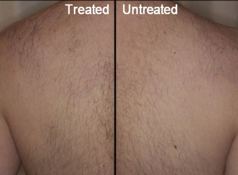 Back comparison of treated and untreated skin, split down the center.