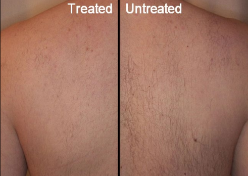 Split-view back skin labeled “Treated” and “Untreated,” showing differences in texture and blemishes