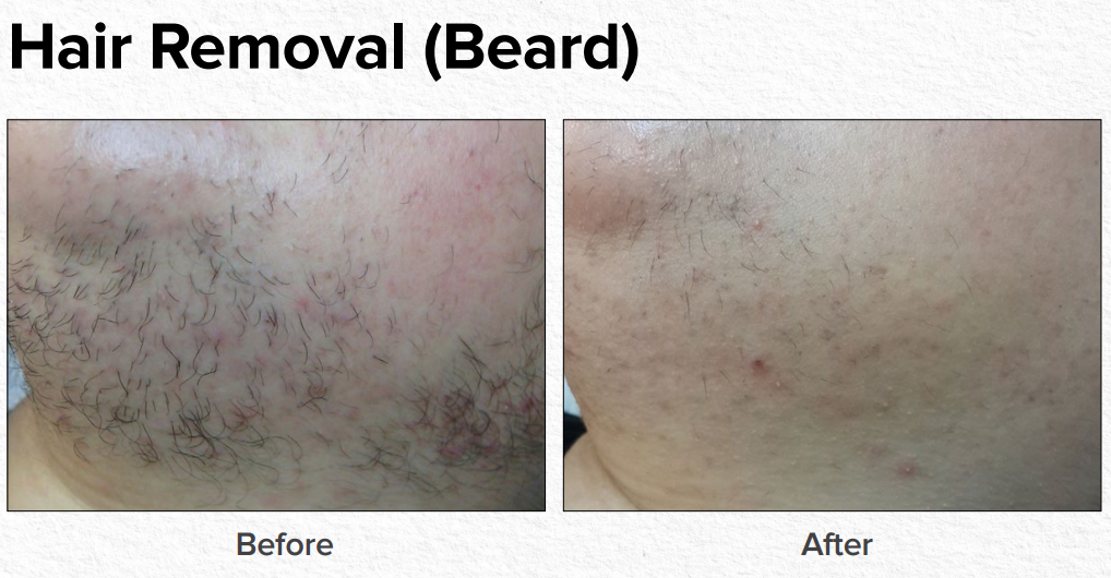 Before-and-after beard hair removal showing reduced stubble and redness on skin.