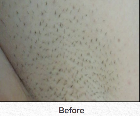 Close-up of stubbled skin with the word “Before” at the bottom.