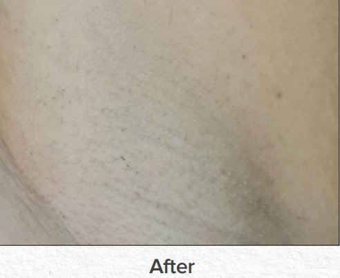 Close-up of light skin texture with faint marks, labeled “After” below