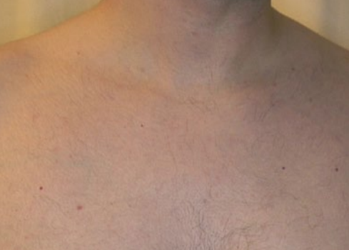 Close-up of a bare upper chest and neck with a small dark spot on the skin.