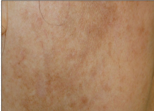 Close-up of light brown skin with faint reddish patches and visible texture