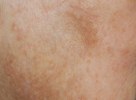 Close-up of mottled reddish-brown skin with a faint rash-like pattern