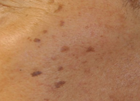 Close-up of skin with several small dark freckles or moles