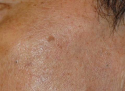 Close-up of a skin lesion on a forehead with a small dark spot and surrounding brown discoloration