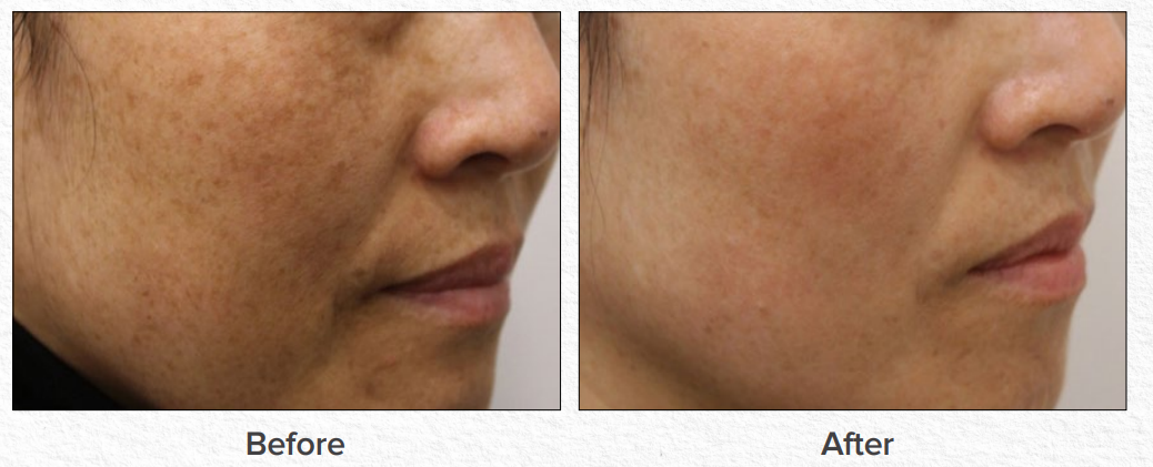 Before-and-after side-profile close-up of a face showing reduced dark spots and smoother skin