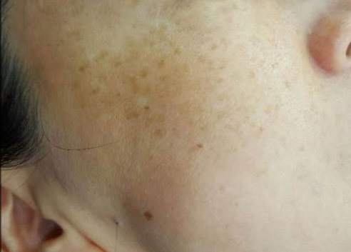 Close-up of a cheek with scattered freckles and a small mole near the nose