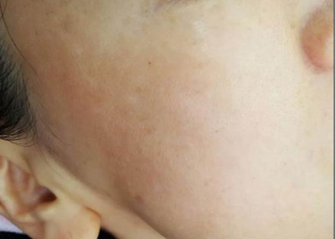 Close-up of a cheek with small skin blemishes and an ear at the edge