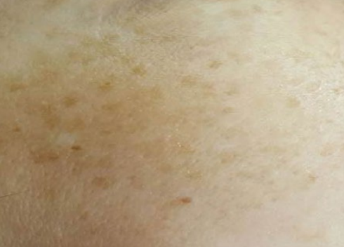 Close-up of light skin with scattered small brown spots and freckles