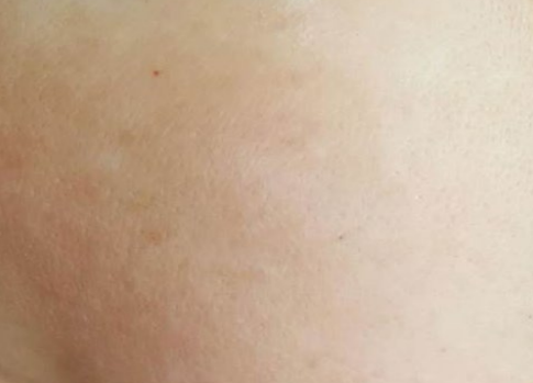 Close-up of light tan skin with faint reddish patches and a small dark spot