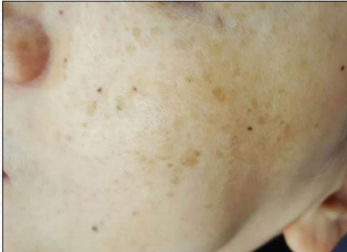 Close-up of a pale cheek with small brown freckles and a visible ear edge