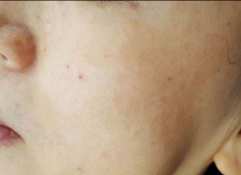Close-up of a cheek with a few small red blemishes near the nose and ear