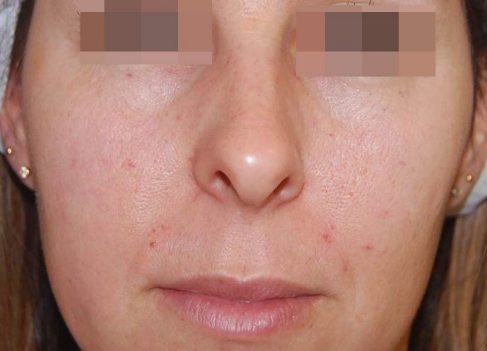 Close-up of a face with red acne marks and skin irritation on the cheeks and chin