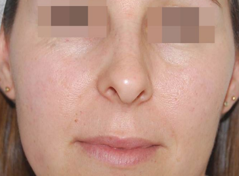 Close-up of a face with sparse eyebrows and subtle facial redness, neutral expression.