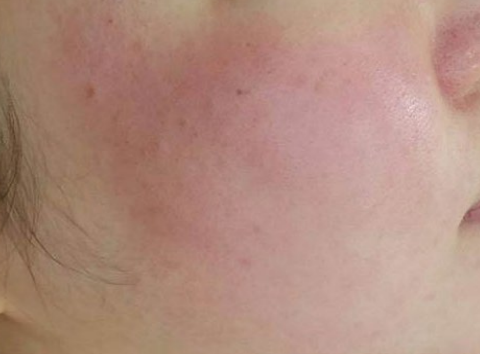 Close-up of a cheek with a small red blemish on pale skin