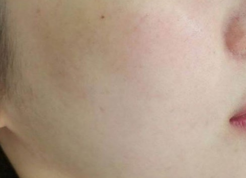 Close-up of a person’s cheek and lips against a plain light background