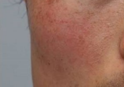 Close-up of a red, irritated rash on skin near the cheek and neck