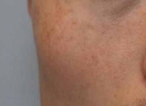 Close-up of a cheek with faint reddish blemishes and skin texture