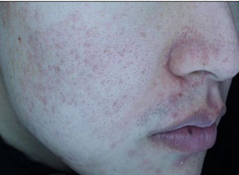 Close-up of a face with red, blotchy skin and small acne-like spots on the cheek and nose area