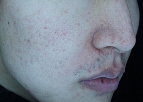 Close-up side profile of a person’s face with acne and facial stubble