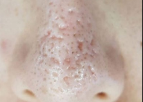 Close-up of a nose with visible blackheads and acne on the skin
