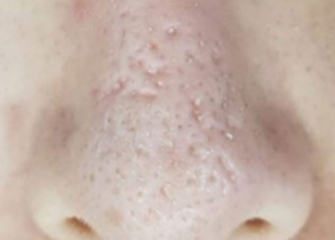 Close-up of a nose with visible blackheads and skin blemishes