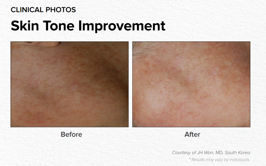 Clinical photos of skin tone improvement, with before and after close-up patches.