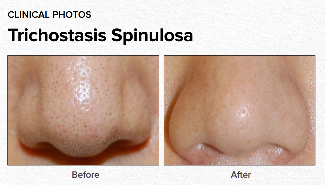 Before-and-after clinical photos of trichostasis spinulosa on a nose, showing smoother skin after treatment