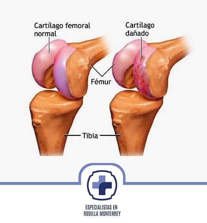DR. JESÚS CRUZ PASQUEL - ARTROSIS