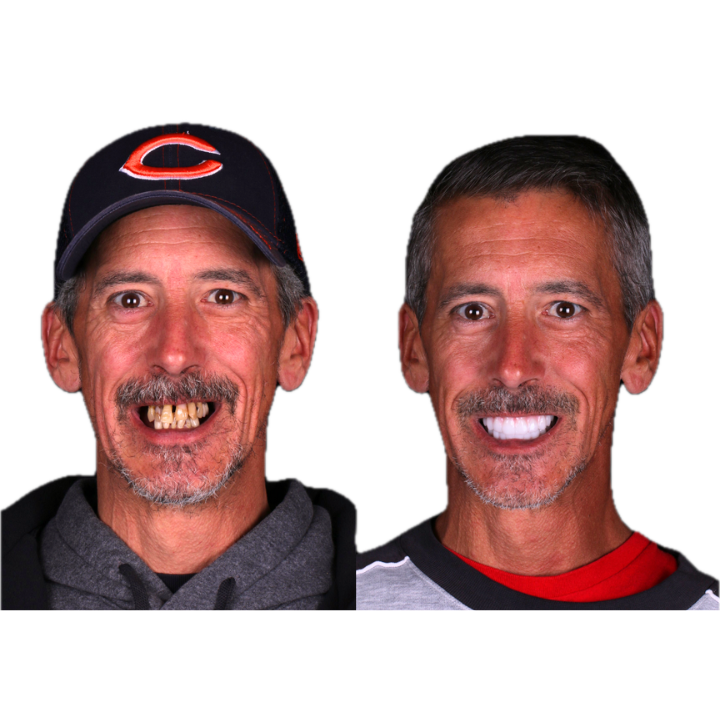 Before and after photos of a man with dental work. Left, man with crooked teeth. Right, man with a bright smile.