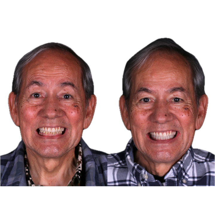 Two smiling men side-by-side, each wearing a different patterned shirt. Their teeth look similar in each image.