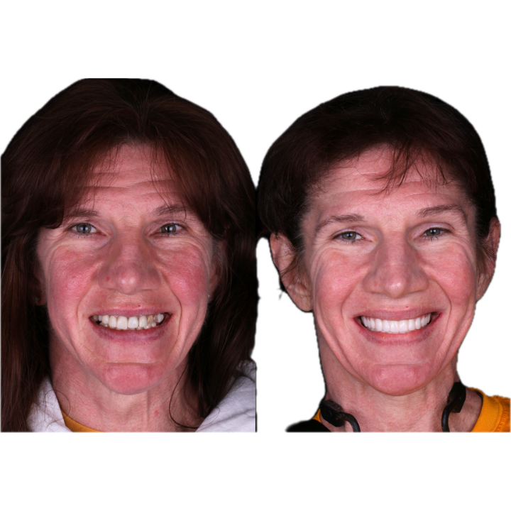 Side-by-side photos of a woman smiling, before and after dental work, showing a brighter smile in the second photo.