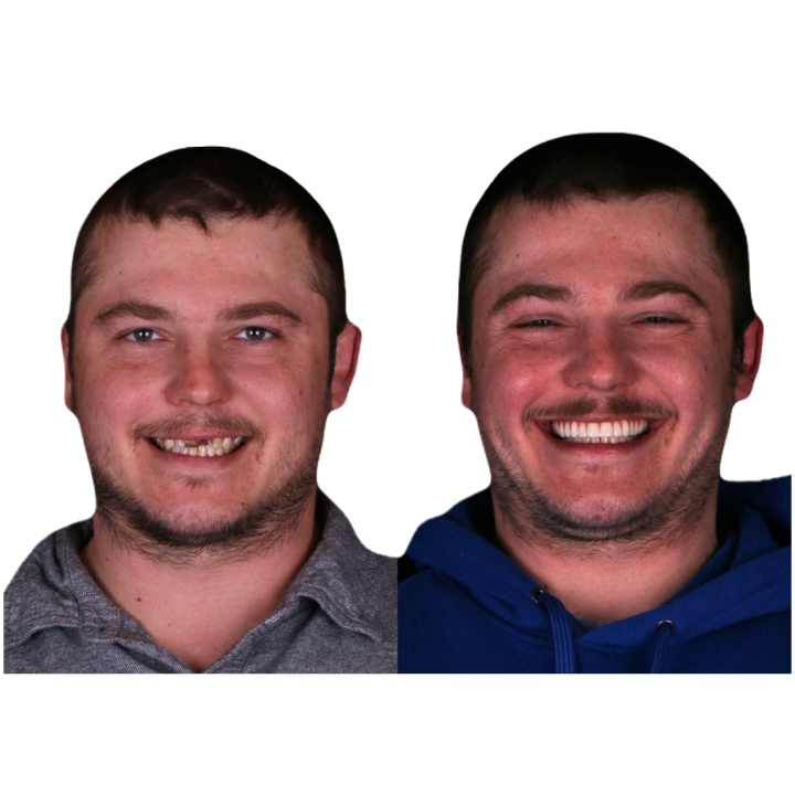 Before and after photos showing a person with missing teeth versus a full smile after dental work.