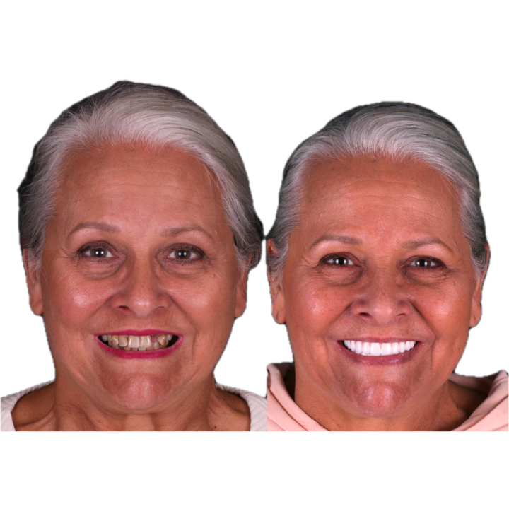 Woman's face with missing teeth before, and smiling with new teeth after dental work.