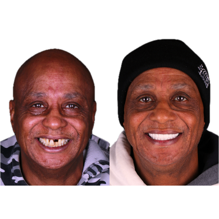 Before-and-after of a person's smile. The first shows missing teeth, and the second shows a bright white smile.