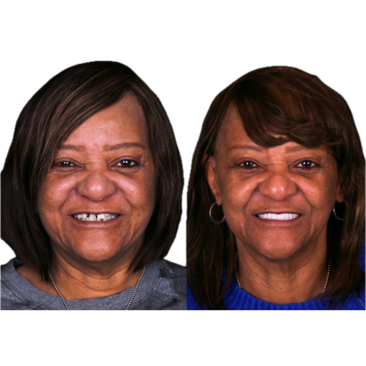 Side-by-side comparison of woman's before and after dental work. She smiles broadly with improved teeth.